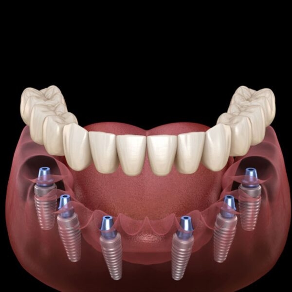 Full Arch Implantology (All on 4)