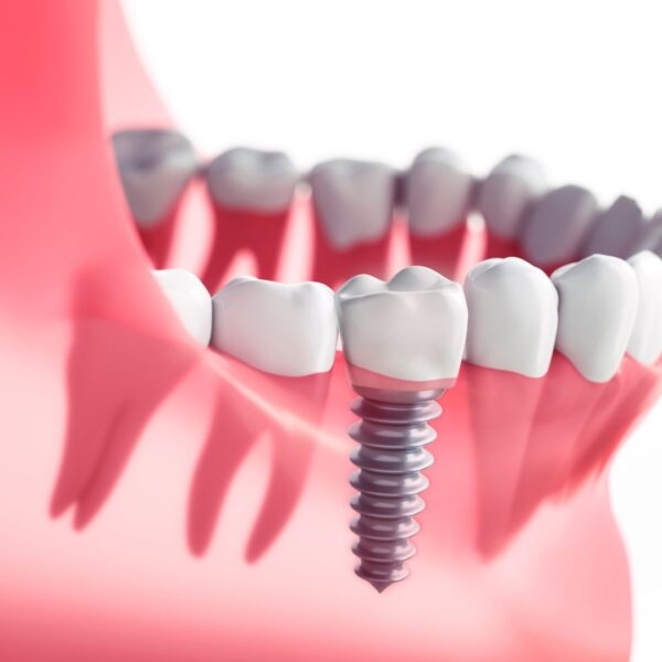 Basic Implantology