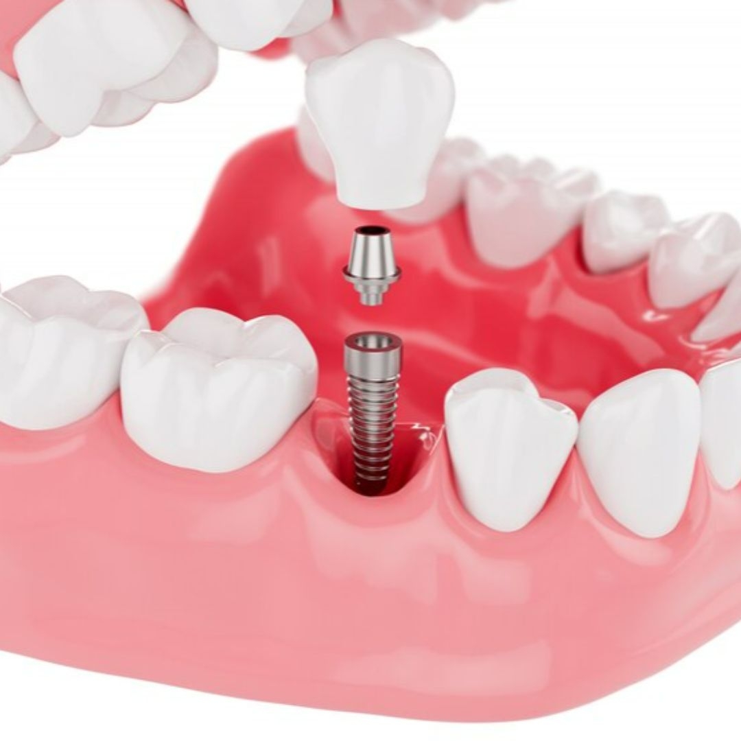 Guided Implantology