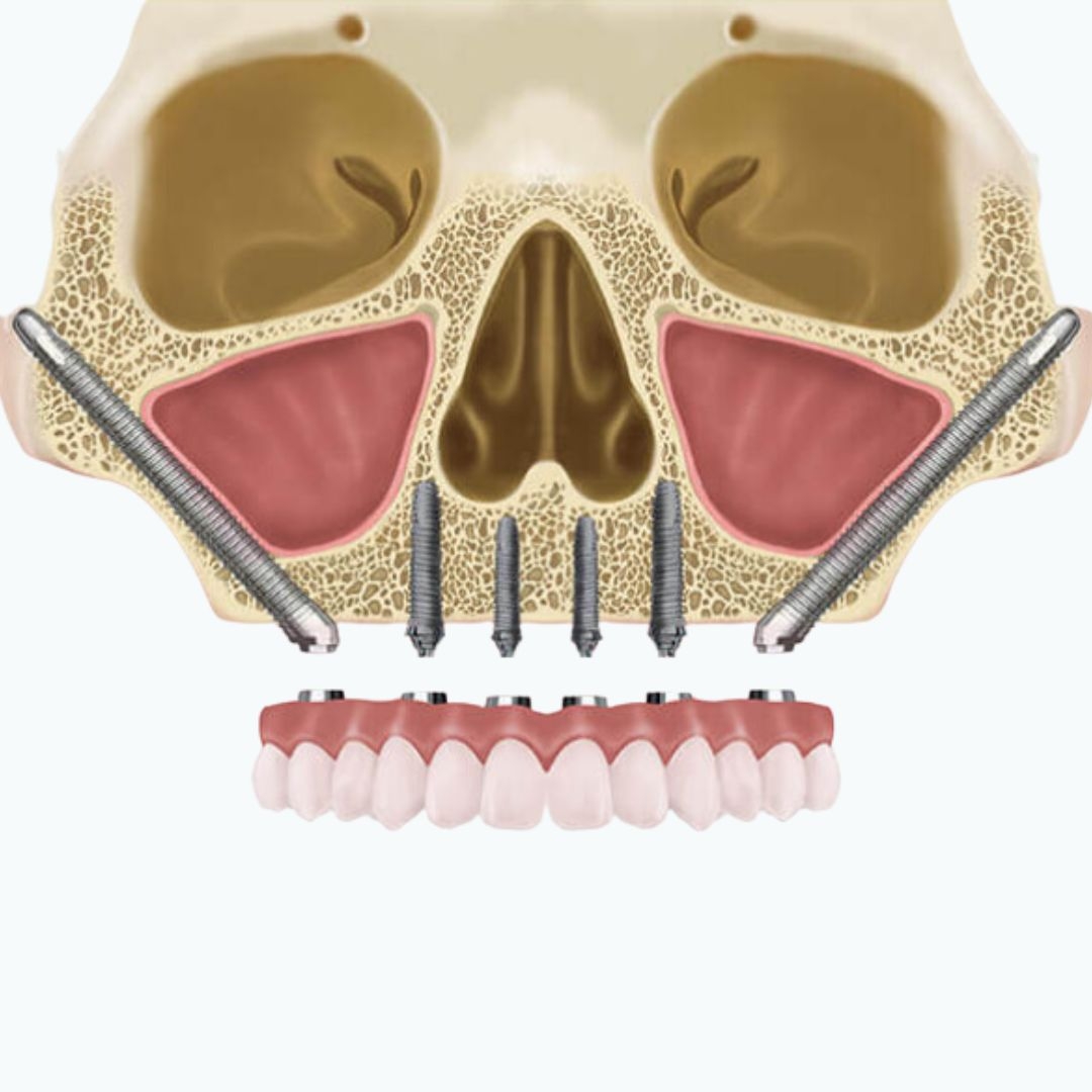 Zygomatic Implants (S.A.F.E protocol)
